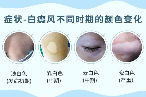 南阳白癜风患者推荐医院“南阳白癜风医院”：警惕错误疗法加重病情！(图1)