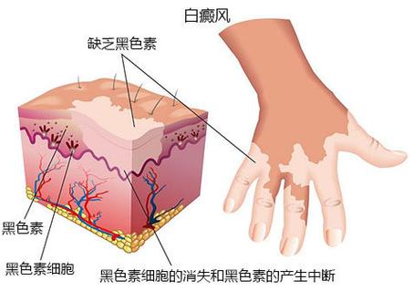 南阳白癜风医院排行榜-孕妇该如何治疗白癜风？(图1)